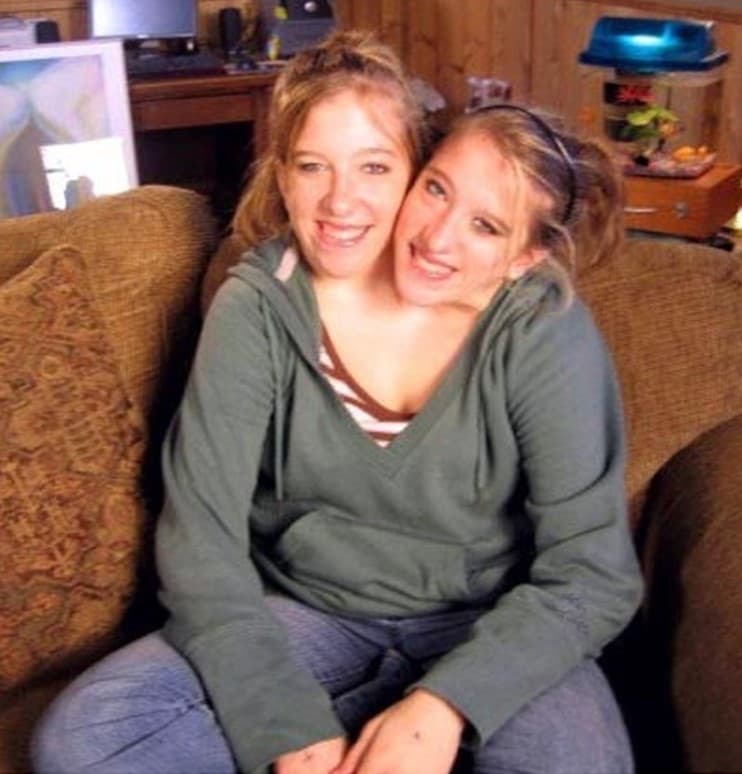 See What Famous Conjoined Twins Abby and Brittany Hensel 